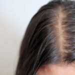 Vitamin Deficiencies That Will Cause Hair Loss