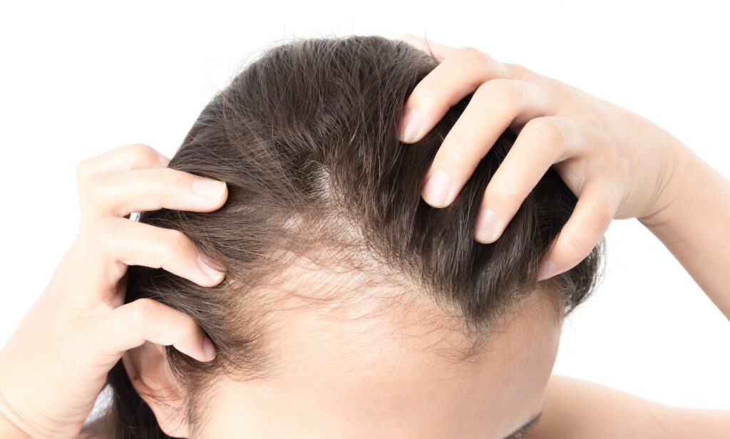 Woman with serious hair loss problem from hormone imbalance, insufficient collagen and vitamins.