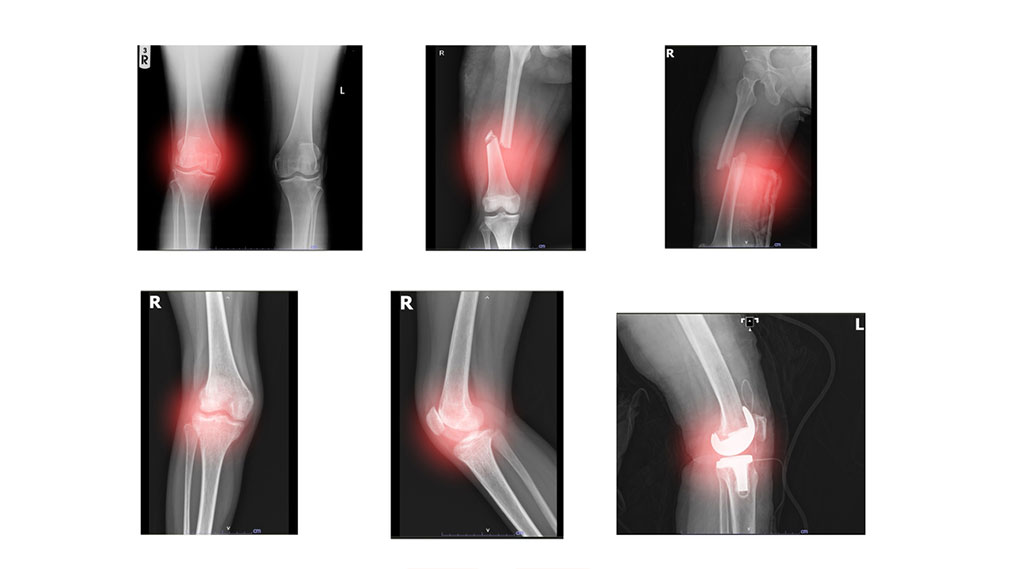 Chronic inflammation in joints